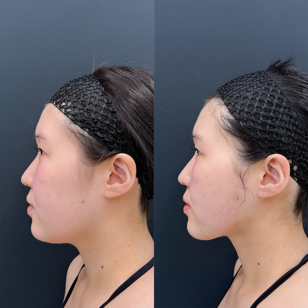 https://purelys-tokyo-clinic.com/wp/wp-content/uploads/2026/08/face-Liposuction_Case-No.701.jpg