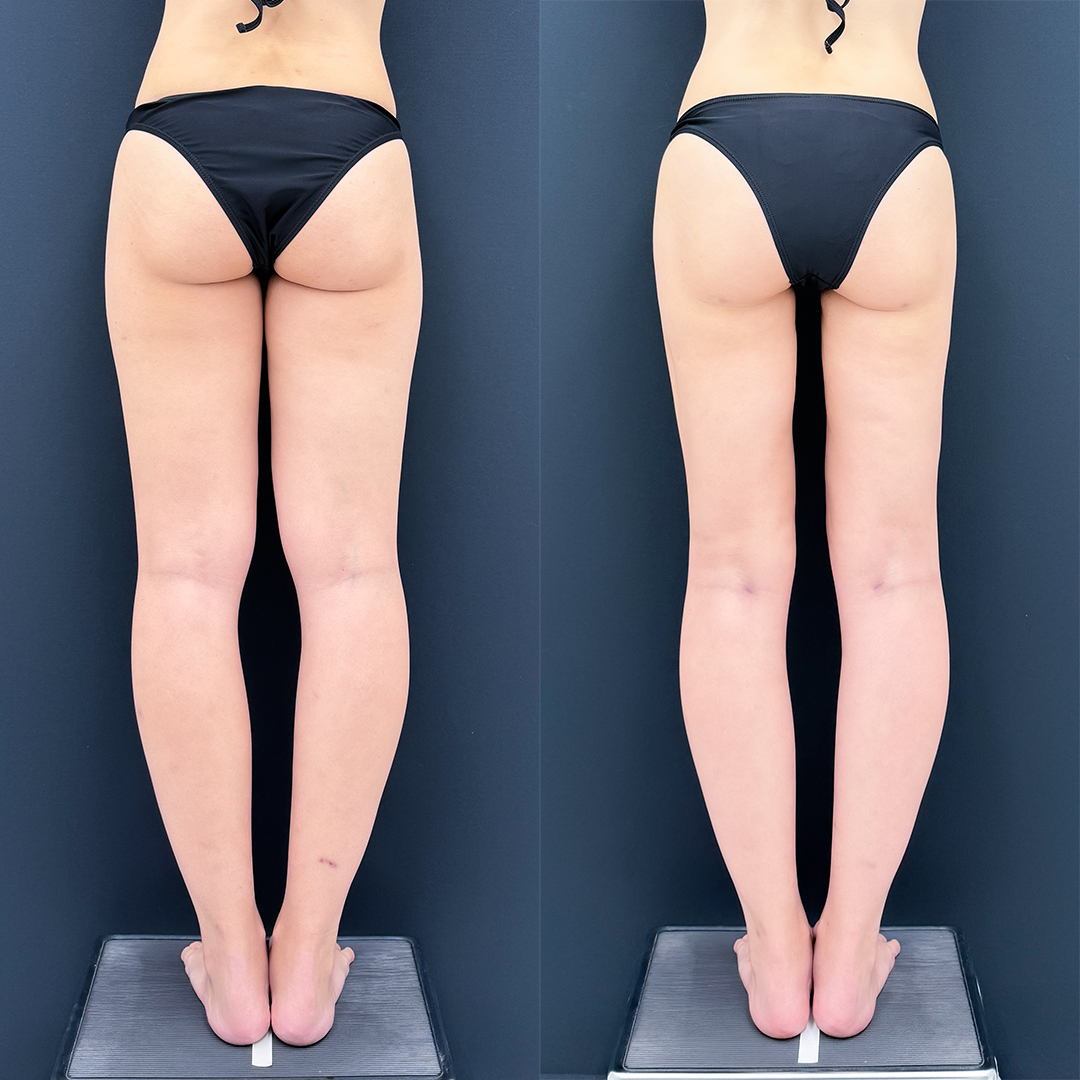 https://purelys-tokyo-clinic.com/wp/wp-content/uploads/2026/08/leg-Liposuction_Case-No.2120.jpg